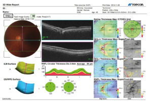 Ryc. 5. Raport szerokopolowego badania OCT oka lewego – wizualizacja i analiza obszaru na dnia oka o wymiarach 9x12 mm z przedstawieniem graficznym m.in. grubości warstwy włókien nerwowych wokół tarczy nerwu wzrokowego z uśrednionymi wartościami w poszczególnych kwadrantach i sektorach z odniesieniem do bazy normatywnej – kolor zielony sugeruje wartości prawidłowe.