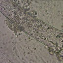 Nużeniec – diagnostyka i leczenie zakażeń
