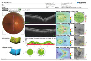 Ryc. 2. Raport szerokopolowego badania OCT oka prawego. Wizualizacja i analiza obszaru na dnia oka o wymiarach 9x12 mm z przedstawieniem graficznym m.in. grubości warstwy włókien nerwowych wokół tarczy nerwu wzrokowego z uśrednionymi wartościami w poszczególnych kwadrantach i sektorach z odniesieniem do bazy normatywnej.