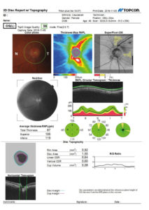 Ryc. 6. Raport badania OCT z analizą parametrów tarczy nerwu wzrokowego oka lewego; graficznie przedstawiona grubość warstwy włókien nerwowych wokół tarczy nerwu wzrokowego z uwzględnieniem średnich wartości grubości RNFL w poszczególnych segmentach; tabelarycznie natomiast przedstawione są parametry dotyczące powierzchni tarczy nerwu wzrokowego, pierścienia neuroretinalnego, a także wielkość zagłębienia na tarczy nerwu wzrokowego oraz objętość zagłębienia.